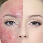 How to get rid of acne without resorting to heavy-handed creams? Go natural and try our 10 home remedies for acne-prone skin. From the all-rounder turmeric to the soothing aloe and the flavourful cinnamon, we have 10 homemade face packs including a toner and a cleanser for acne-free skin. Keep reading for a basic skincare routine for oily skin.