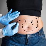 Hempas lemak berlebih di badan dan tampil lebih percaya diri dengan badan yang lebih ideal dengan melakukan liposuction di Jakarta