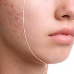 Pimples are a common skin problem amongst teenagers; however, for some, the issue continues into their adulthood. There could be various reasons right from the type of skin to improper diet to hormones. There are several surefire ways in which you can get rid of the pimples permanently. In this post, various factors that cause pimples, acne, and other related issues and how to get rid of pimples.