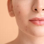 Kulit berjerawat bikin kita kurang percaya diri. Untuk itu, kamu harus merawatnya dengan benar. Gunakan skincare anti acne yang tepat mulai dari pembersih wajah hingga pelembapnya. Produk anti acne setidaknya harus mengandung bahan seperti salicylic acid, zinc, retinol, hingga vitamin C agar bisa berfungsi maksimal. Nah, untuk pelembap kulit berjerawat, kamu bisa cek rekomendasi dari BP-Guide!