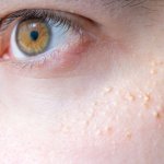 Klinik skin care memang dipercaya untuk mengatasi hampir semua masalah kulit, termasuk milia. Untuk kamu yang berdomisili di Bandung dan sedang mencari klinik estetika wajah, BP-Guide secara khusus akan membagikan beberapa klinik kecantikan populer yang juga mampu mengatasi milia. Wajah cantik mojang geulis pun akan makin mudah didapatkan. Simak sampai habis ya!