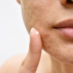 Jerawat bisa jadi penghalang kamu untuk tampil percaya diri. Maka dari itu, saat jerawat muncul, kamu wajib segera membasminya. Supaya tampilan kulit bisa segera mulus, maka kamu wajib melakukan perawatan yang tepat pada kulit wajah kamu. Selain itu, gunakan juga skincare atau obat jerawat agar kondisi kulit lebih cepat pulih. Intip rekomendasinya dari kami!