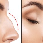 Apakah Anda berencana melakukan prosedur Rhinoplasty? Yuk ketahui informasi seputar Rhinoplasty terlebih dulu dan beberapa rekomendasi tempat yang melayani Rhinoplasty di Surabaya.