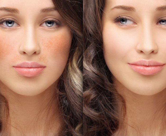 cream to remove pigmentation from face permanently