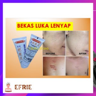 Salep Cream Krim Penghilang Bekas Luka Jerawat Cacar Hitam Merah Ampuh