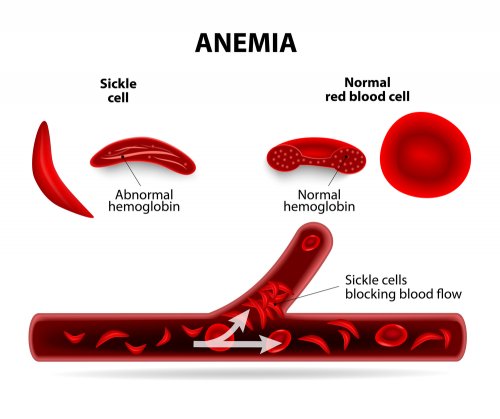 Merupakan penyakit yang disebabkan kekurangan anemia 10 Penyakit