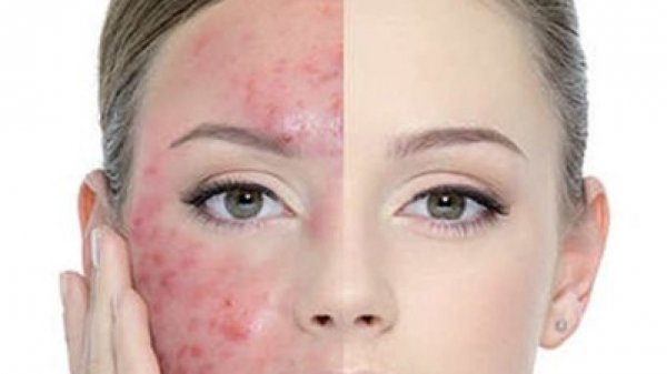 Tormented by Acne: 10 Home Remedies for Acne According to Experts and the Skincare Formula for Acne Free Skin!
