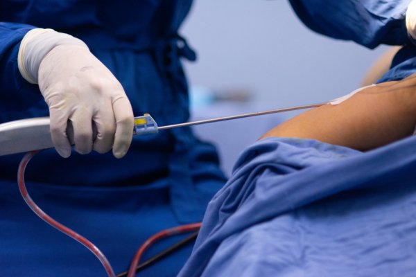 3 Rekomendasi Klinik Liposuction di Surabaya untuk Hilangkan Lemak (2023)
