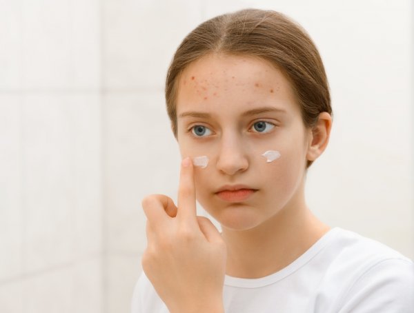 Segera Coba! 15 Rekomendasi Skincare untuk Kulit Kering Berjerawat yang Cocok bagi Remaja! (2023)