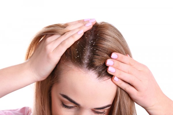 Don't Let Dandruff Become an Embarrassment. Top Hair Oils to Remove Dandruff and Provide Relief to Your Itchy Scalp, Plus, Simple Home Remedies to Control Dandruff (2020)
