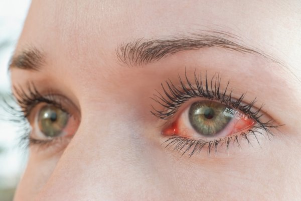 Tại sao mắt lại đỏ? Nguyên nhân, cách khắc phục và phòng tránh cho đôi mắt bạn sáng khỏe (năm 2022)