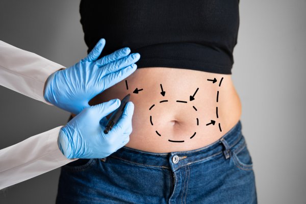6 Rekomendasi Klinik Liposuction di Jakarta Bantu Kamu Hempas Lemak Berlebih dan Tampil Lebih Percaya Diri (2023)