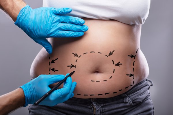 Menghilangkan Lemak dengan Cepat Melalui 5 Rekomendasi Klinik Liposuction di Semarang (2023)