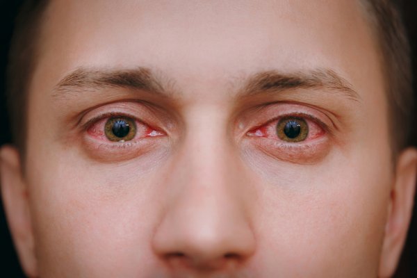 Sakit Mata? Ini Rekomendasi Obat Tetes Mata Terbaik untuk Kamu! (2023)