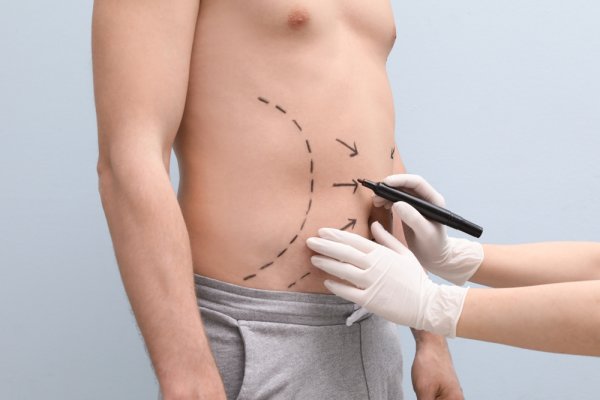 Miliki Bentuk Tubuh Ideal dengan Treatment di 5 Rekomendasi Klinik Liposuction di Makassar (2023)