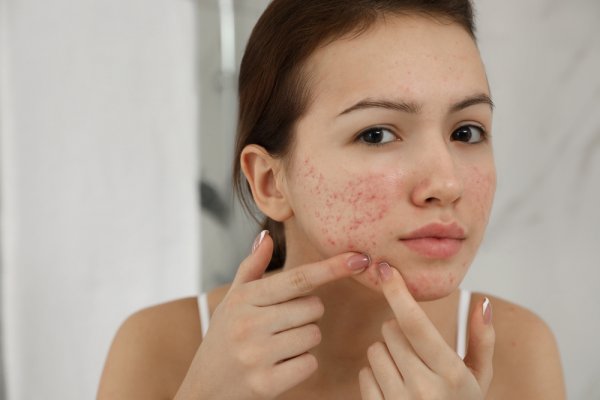 Dapatkan Kulit Bersih dan Sehat dengan 15 Rekomendasi Skincare Terbaik untuk Kulit Berjerawat (2023)