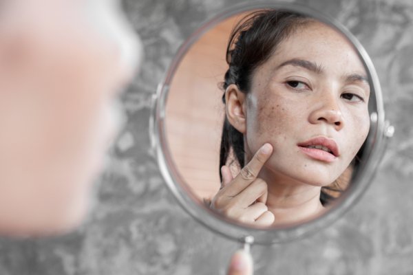 Dapatkan Kulit Wajah Bersih dan Sehat dengan 5 Terapi Menghilangkan Flek di Klinik Kecantikan (2023)