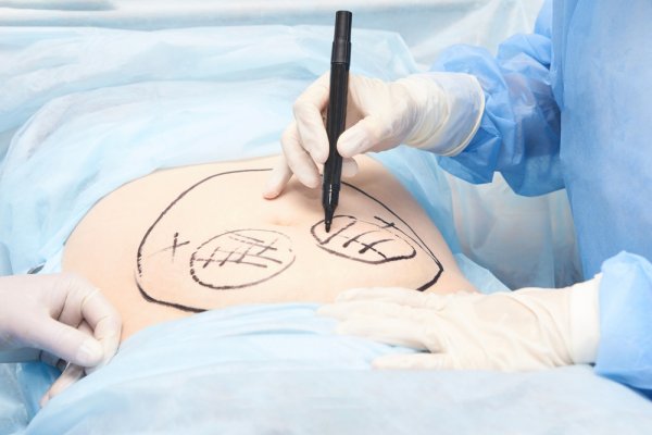 Mudah Menghilangkan Lemak Berlebih dengan 2 Rekomendasi Klinik Liposuction di Palembang (2023)