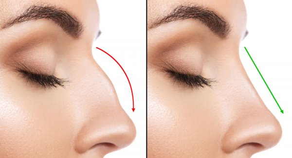 3 Rekomendasi Rhinoplasty di Surabaya Untuk Mengubah Bentuk Hidung